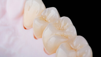 3D-printed ceramics show promise for dental restorations