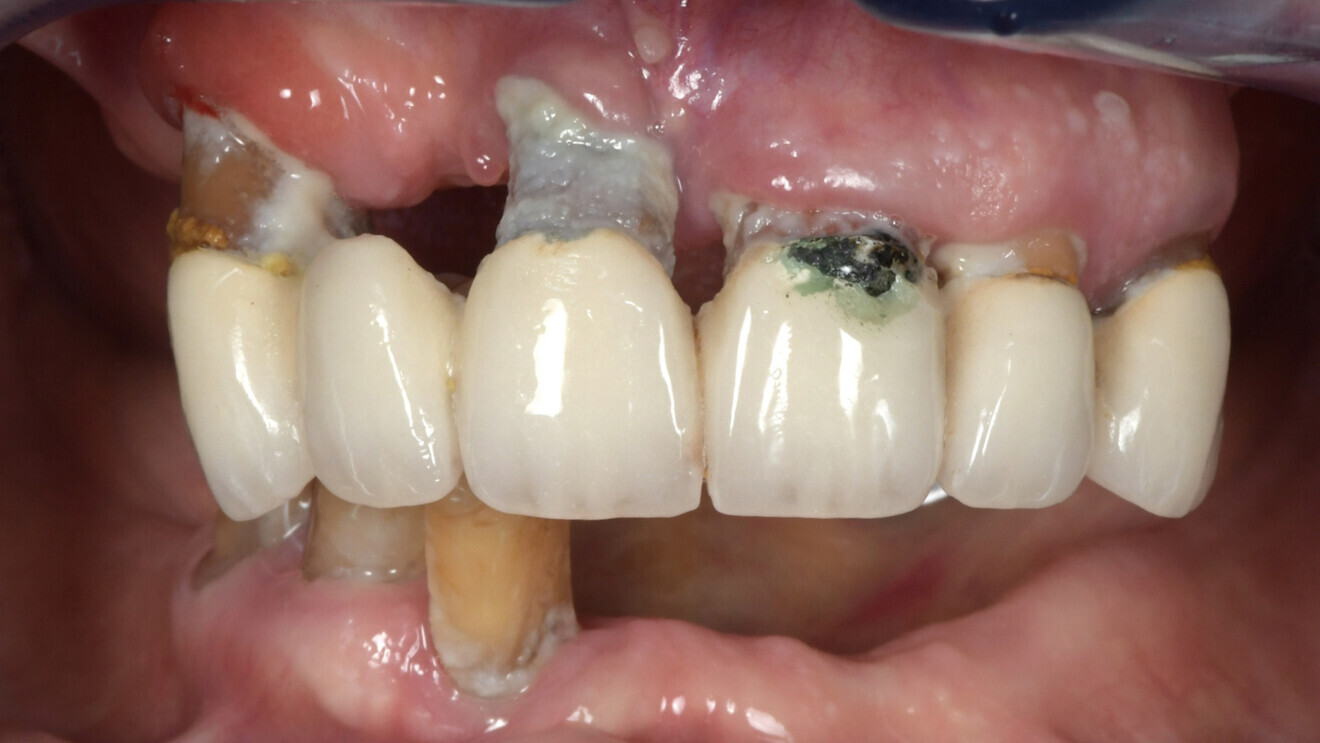 Fig. 2: Intra-oral view of the maxillary bridge, the significant recession and the three residual mandibular teeth.