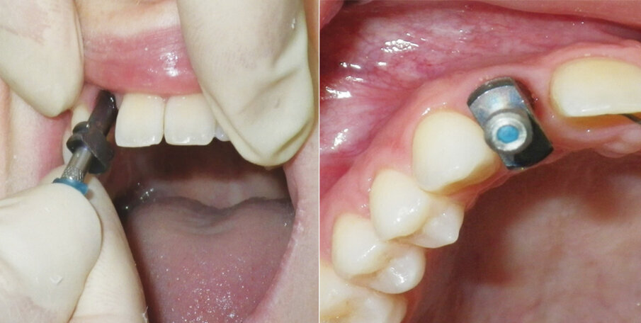 Fig 8. Wax is placed on the impression screw to obturate the driver receptacle.