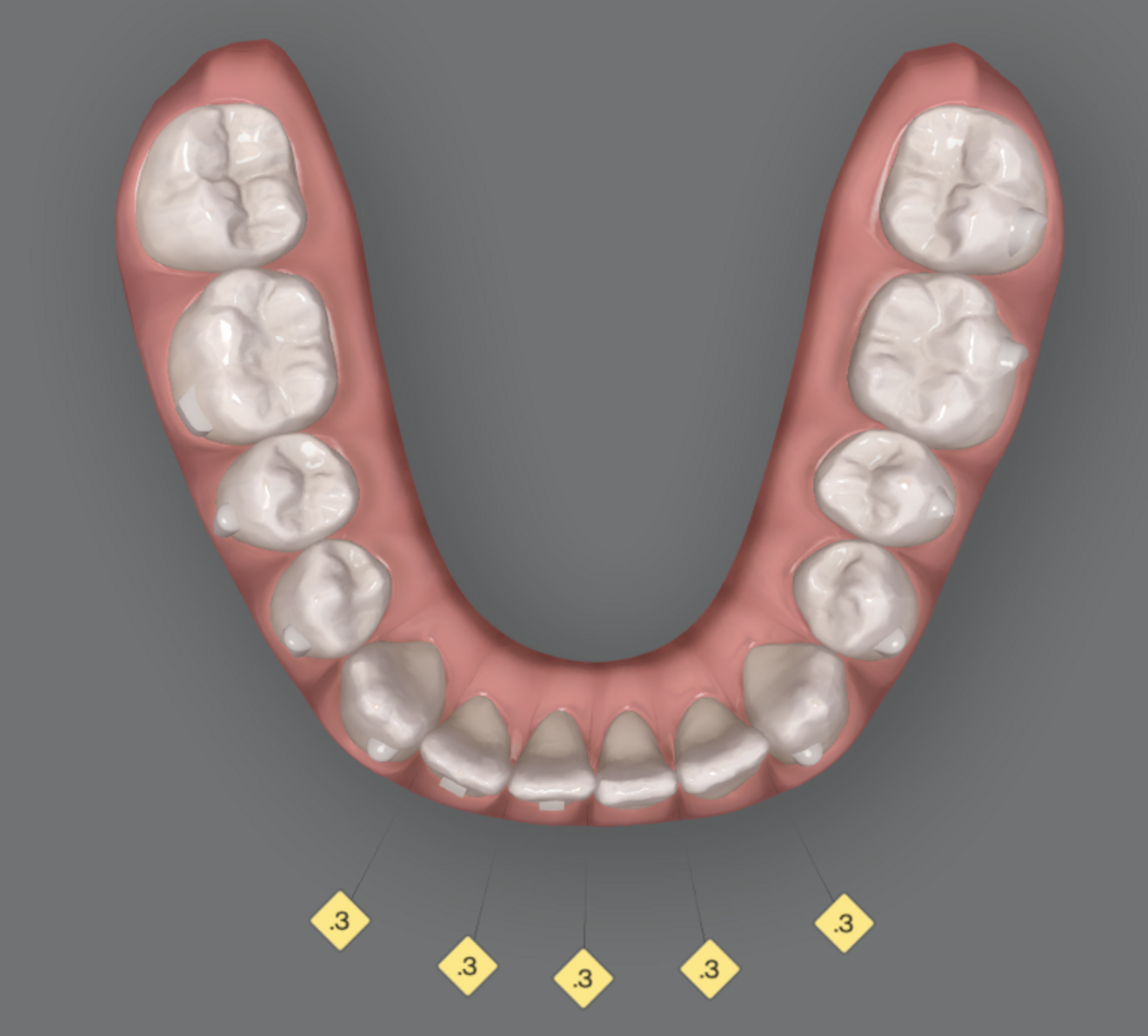 Fig. 1: Ideal stage for IPR.