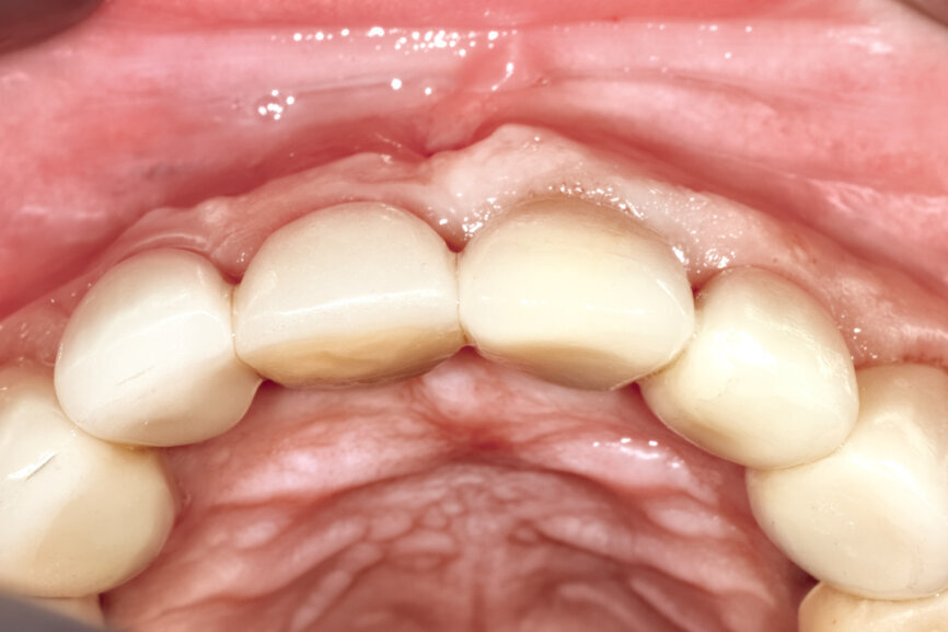 Fig. 30a: The occlusal view revealed the volume maintained with
the soft-tissue cervical contours (a), and the lateral retracted view revealed an excellent soft-tissue emergence profile (b).