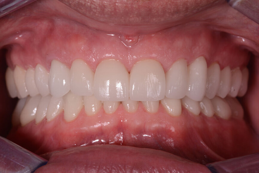 Fig. 13: Intraoral photographs after treatment.
