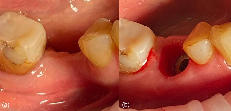 Fig. 22_a) Vista clinica vestibolare pre-operatoria, b) vista clinica vestibolare post-operatoria a 4 mesi.