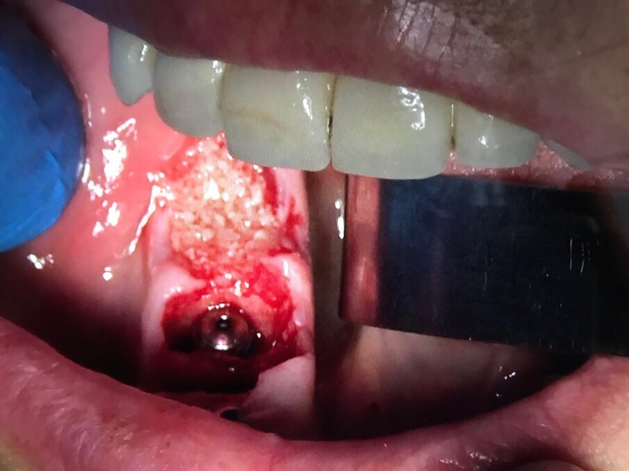 Fig. 12 - Fase 2: Impianti Multysystem inseriti e filino della discrepanza alveolo-implantare con I-PRF addizionato di xenoinnesto.