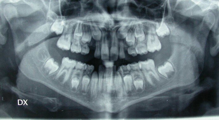 Fig. 12