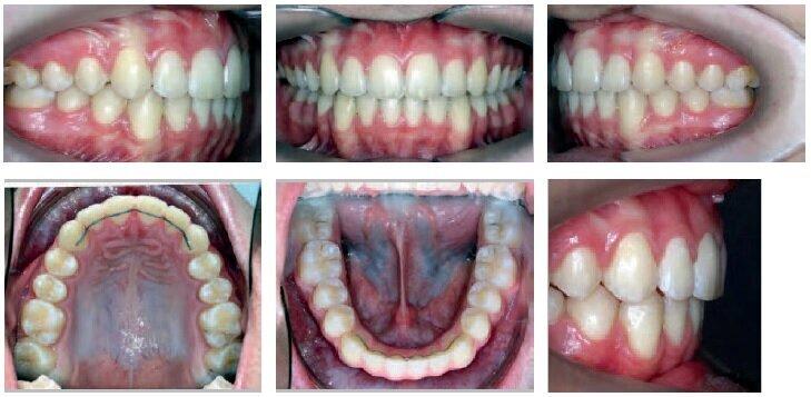 Total Tx Time: 22 months – 5 appointments