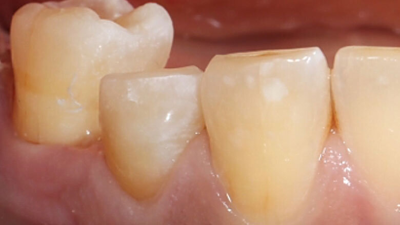 Fig. 4. Únicamente se acortaron por oclusal las paredes remanentes de la cavidad.