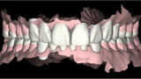 Fig. 3. Escaneado intraoral inicial con Carestream 3500.