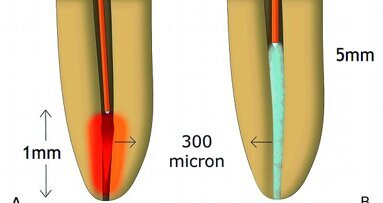 Le laser en endodontie (Partie II)