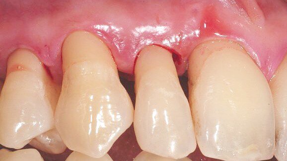 Periodontal decontamination in microsurgery