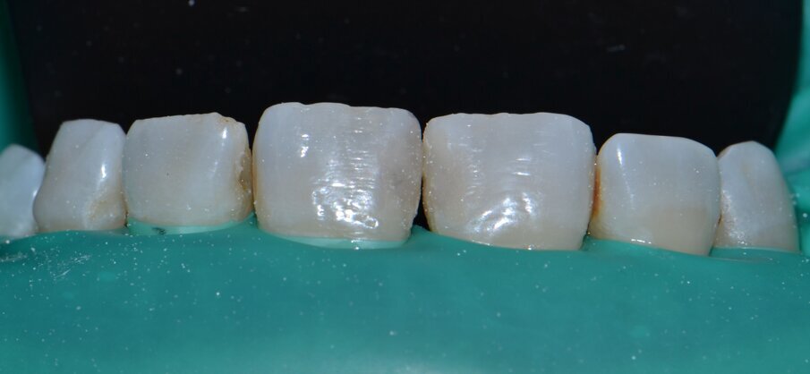 Fig 7: Incisal edge wear