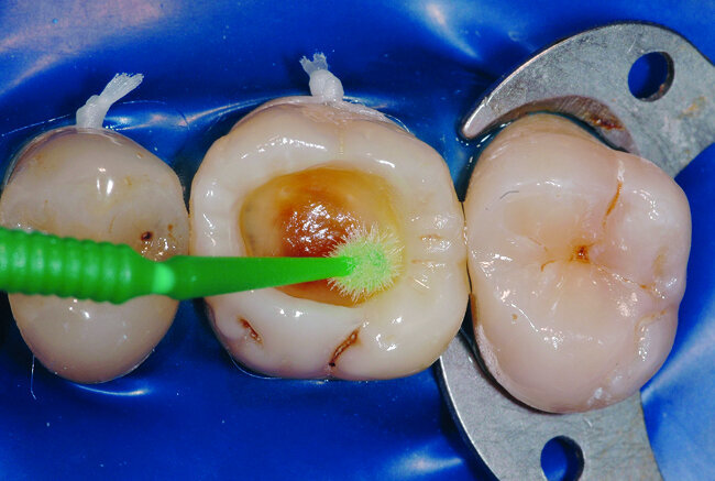 Fig. 20: Un système adhésif est applique en suivant les recommandations du fabricant. Il est important de bien frotter la dentine a l’aide de microbrossette afin de l’imprégner parfaitement de système adhésif. 