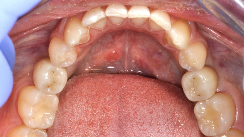 L’approccio “Tooth-Like” in implantologia
