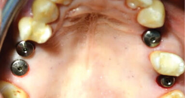 Safe, accurate, simplified sinus-lift technique for general practitioners, Part 2: Introduction of surgical technique