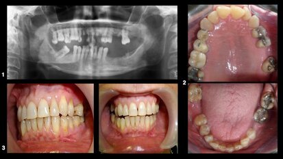 La atención odontológica del paciente con cáncer (1)