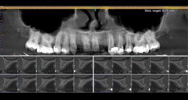 Caso di agenesia dentale trattato con impianti innovativi di diametro ridotto