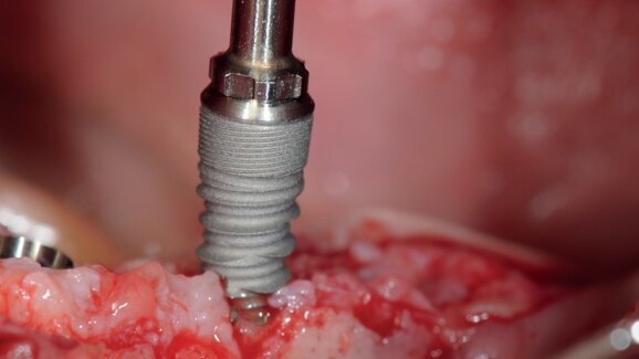 The clinical effects of insertion torque for implants placed in healed ridges: A two-year randomized controlled clinical trial