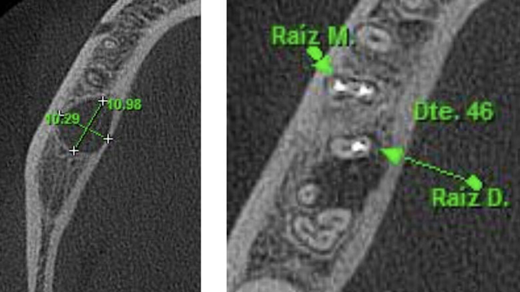 Figura 1. Inclinación de la raíz distal del primer molar inferior derecho hacia lingual. Ubicada aproximadamente a 10 mm de la cortical ósea vestibular, lo que hace imposible hacer el abordaje quirúrgico a través de microcirugía.