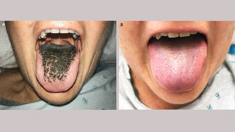 Rare case of black hairy tongue reported
