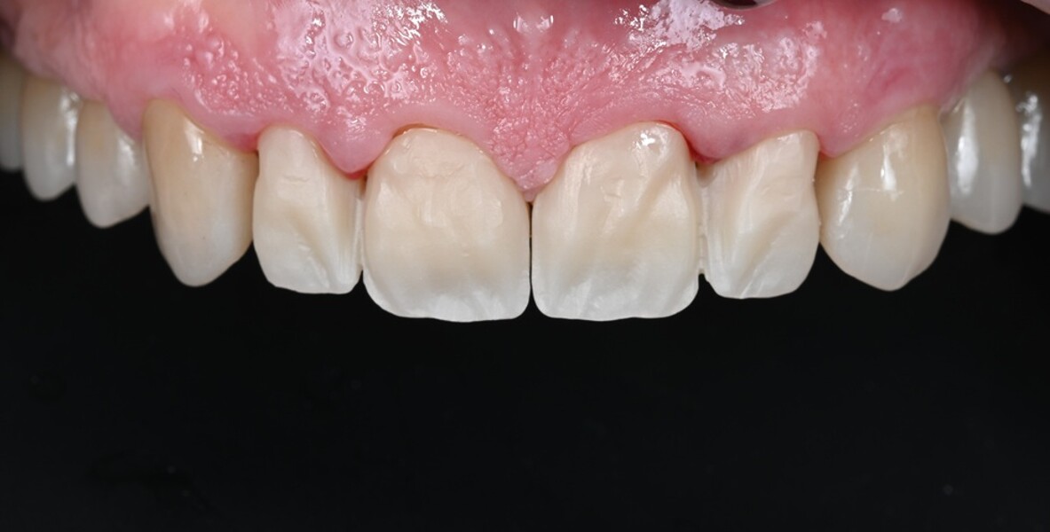 Fig. 4: Try-in of the restorations.