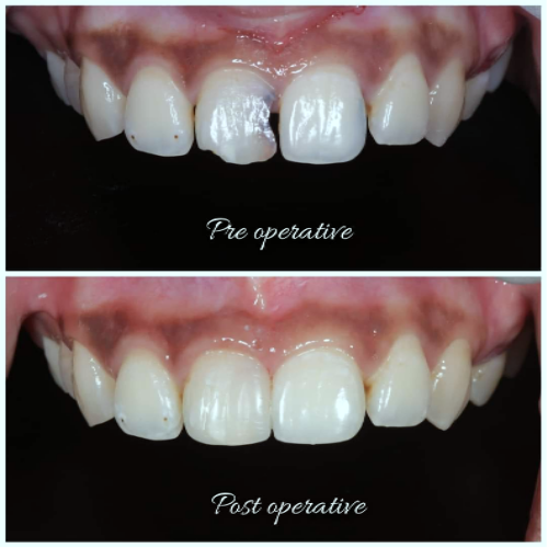 Excellent tooth image which defines not only hue, chroma and value but also explains other properties such opalescence, fluorescence, surface texture and luster. 