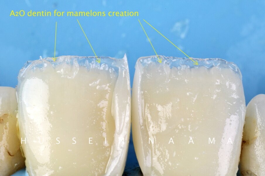 Fig. 9: Mamelons created with deep dentin opaque shade of Beautifil II LS shade A2O.