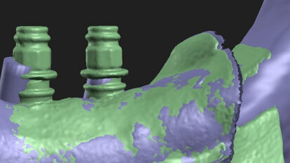 Comparison of guided and non-guided implant placement accuracy (Part 2)