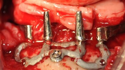 Implant ramowy podokostnowy w chirurgii implantologicznej – opis przypadku.