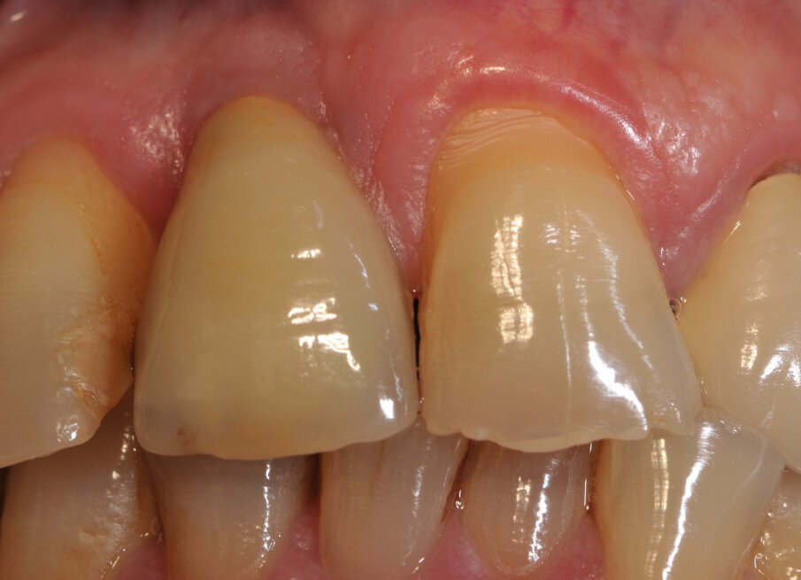 Fig. 16_Stabilità dei tessuti molli perimplantari a 4 anni.