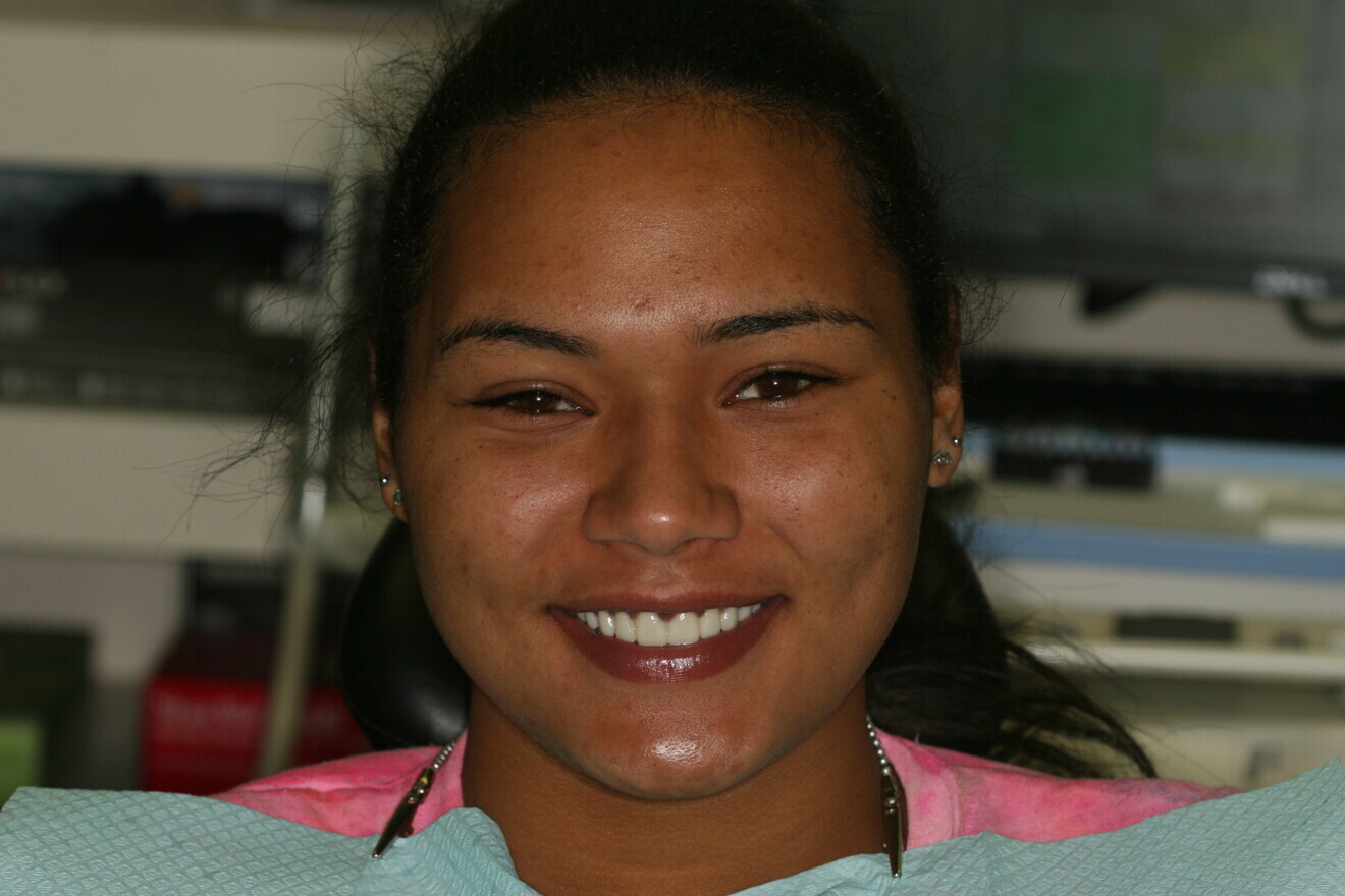 Fig. 6: Full-face view of the approved provisional restorations. 