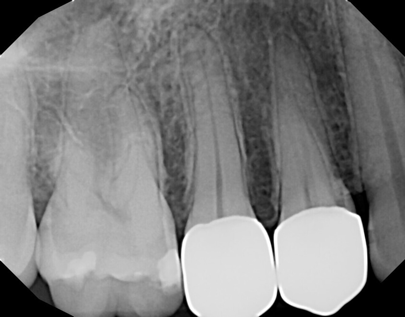 Fig. 19: Periapical radiograph at five years after laser pulp capping and restoration of tooth #15, demonstrating an absence of periapical pathology.