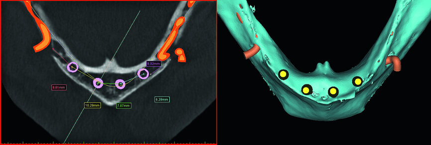 Fig. 9: The axial and 3-D reconstructed views revealing the IAN’s, and four proposed implants in the symphysis.