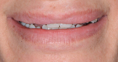 Esigenza di approccio interdisciplinare per l’armonia estetica del sorriso: case report