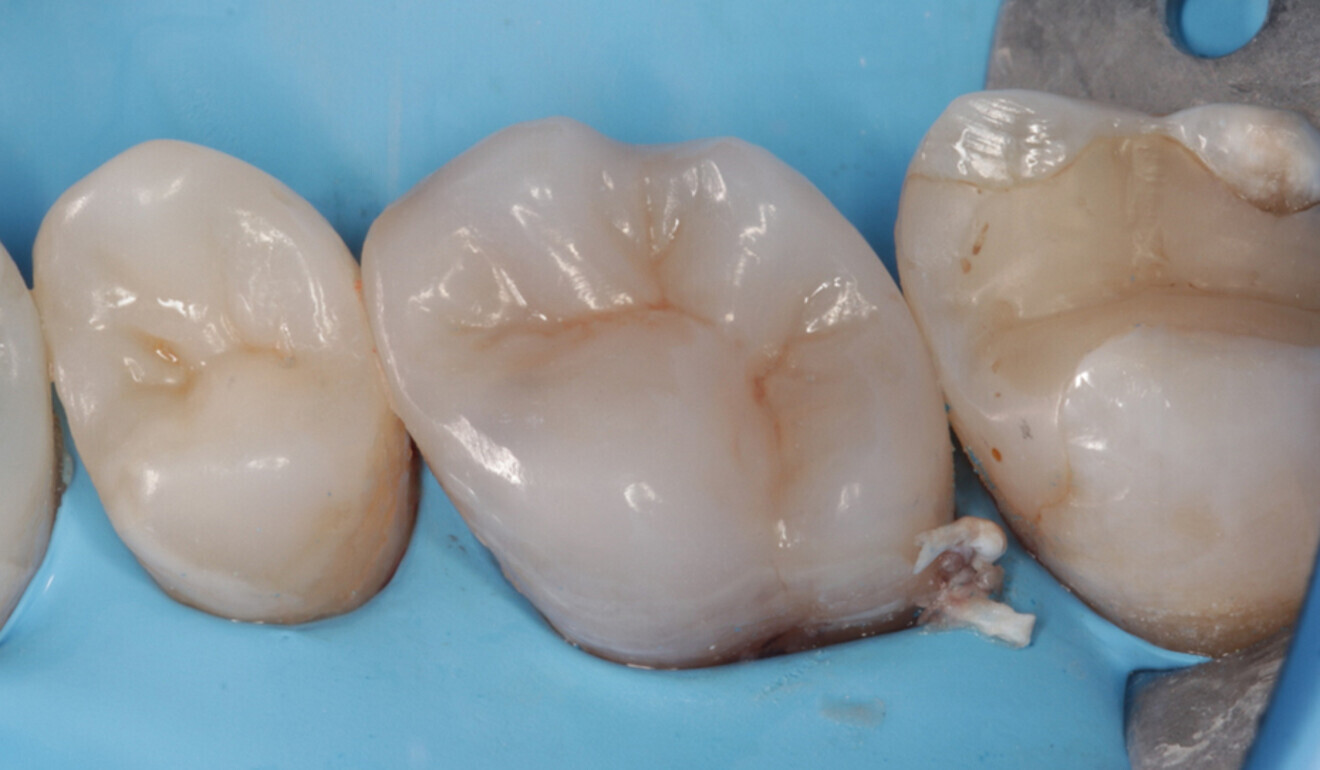 Fig. 17: Occlusal surface after surface modelling with CLEARFIL MAJESTY ES-2 Universal and initial polishing, palatal view. (Image: Kuraray Noritake Dental)