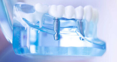 Une nouvelle technologie pourrait améliorer l’intégration des implants dentaires métalliques