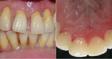 Maintenance of periodontally compromised teeth with direct splinting