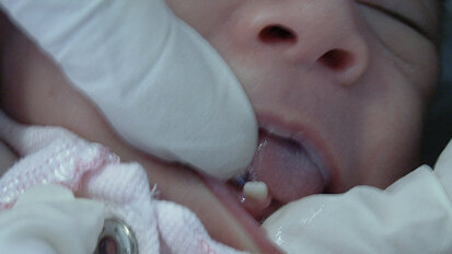 Dientes natales y neonatales