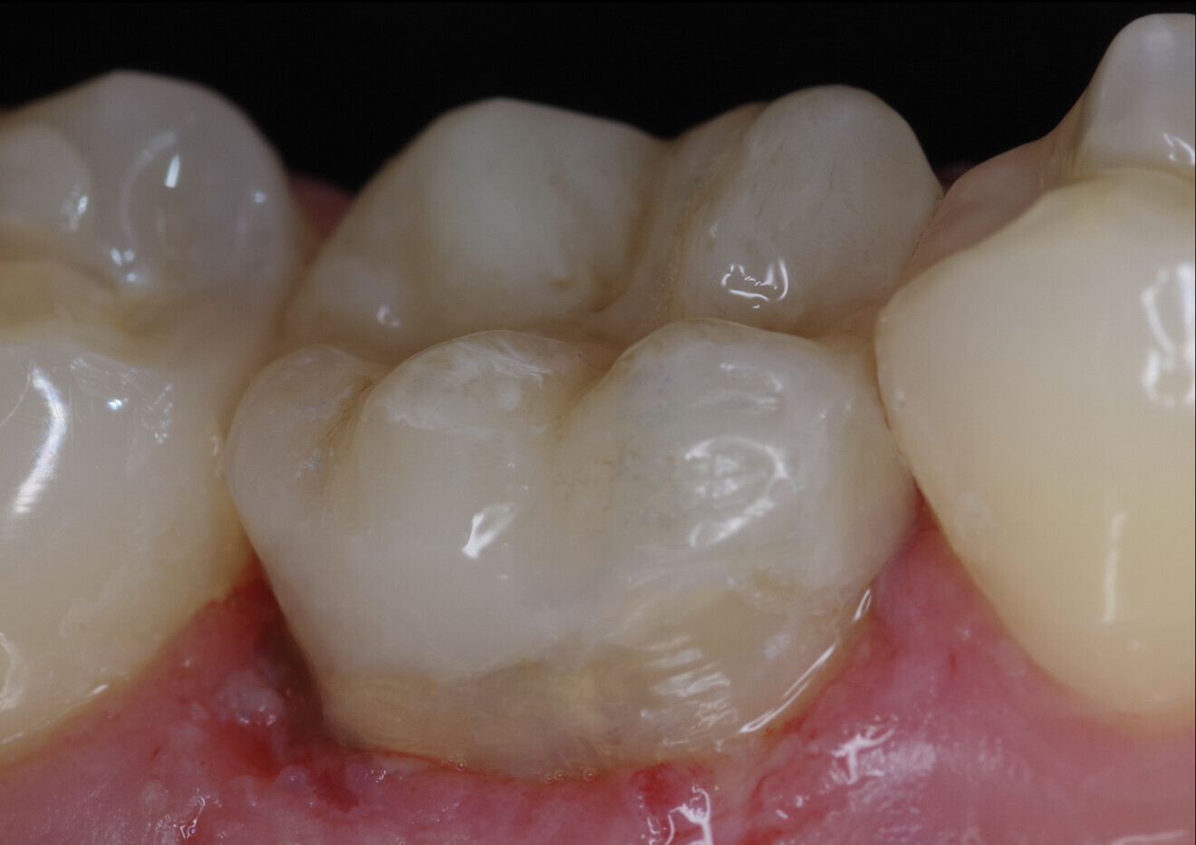 Fig. 21: After placement of the restoration and removal of excess adhesive cement and polishing of the margins and the surface.