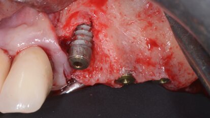 Osseodensificazione, tecnica innovativa per l’elevazione crestale del seno mascellare: Case Report