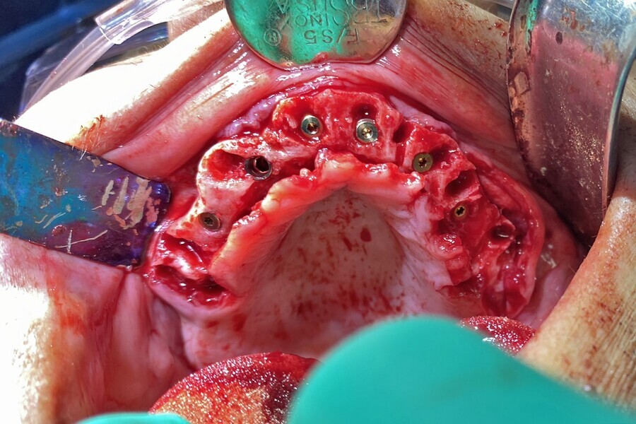 Fig. 19a: Implants and residual sockets.