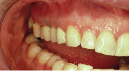 Cosmetic periodontal surgery: pre-prosthetic soft-tissue ridge augmentation (Part 1)