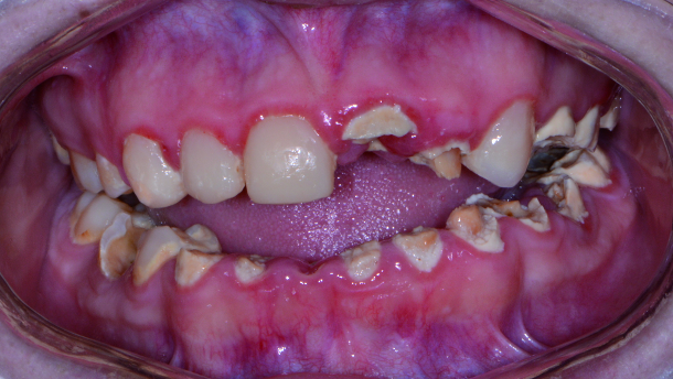 Replacing a failing dentition with new technology