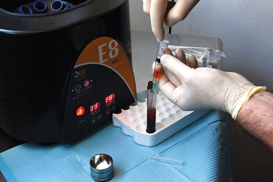 Fig. 12: The plasma (yellow liquid) is drawn out of the centrifuged tube with a syringe.