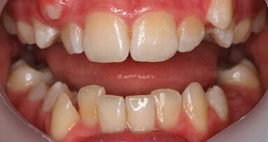 Hard to achieve orthodontic stability? Answer may be blowing in the wind