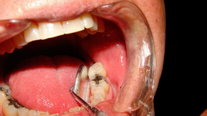 AGD opposes implementation of dental therapy accreditation standards