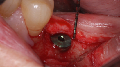 Vertical reconstruction of peri-implant soft tissue