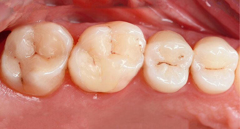Fig. 15: Check-up after 5 years (2013): restorations still look beautiful