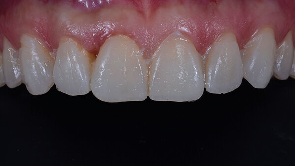 Fig. 8b. Fotografía intraoral del mock-up.