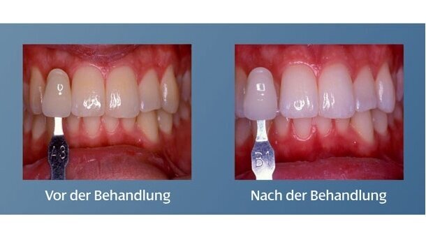 Patientenorientierte Kommunikation mit Whitening Seminaren