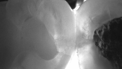 Near-infrared transillumination: Expert introduces X-ray-free caries diagnostic